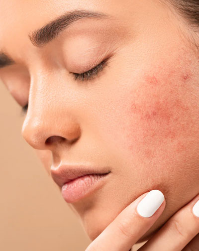 acne and Its scar management