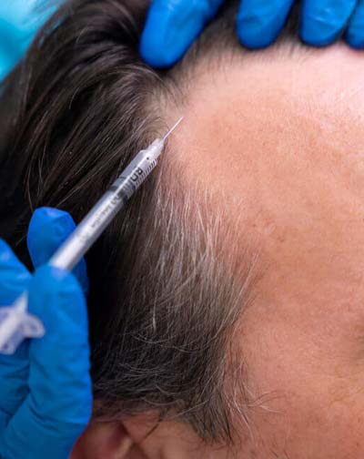 hair transplantation and lipolysi