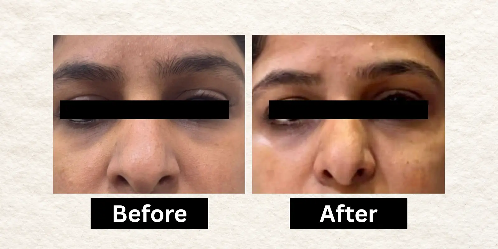 Before After 1