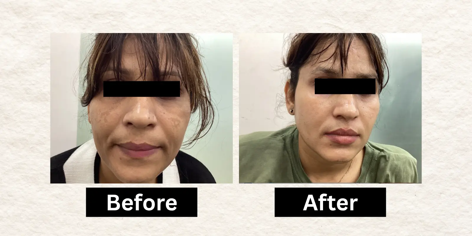 Before After 10
