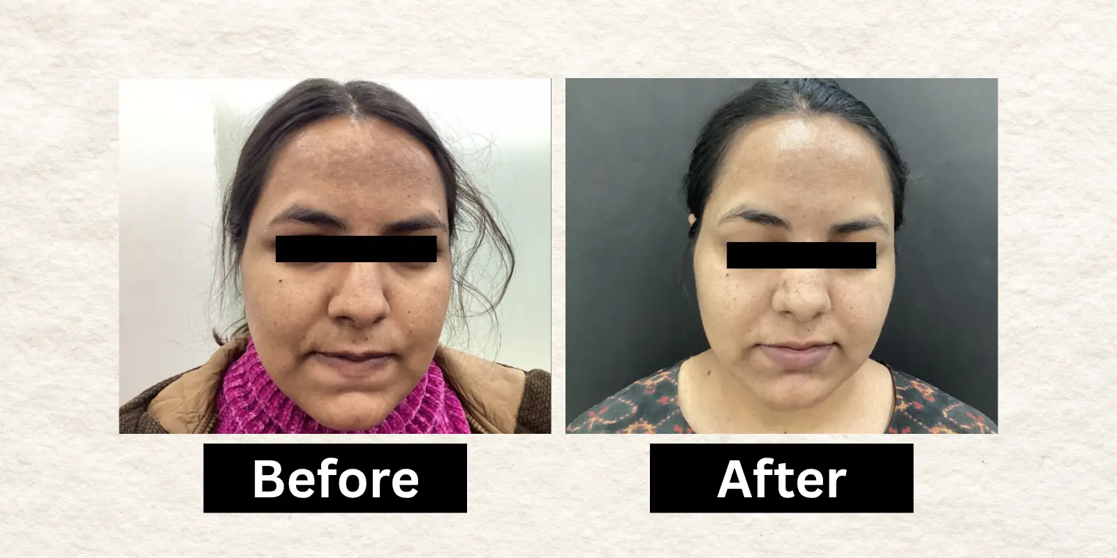 Before After 11