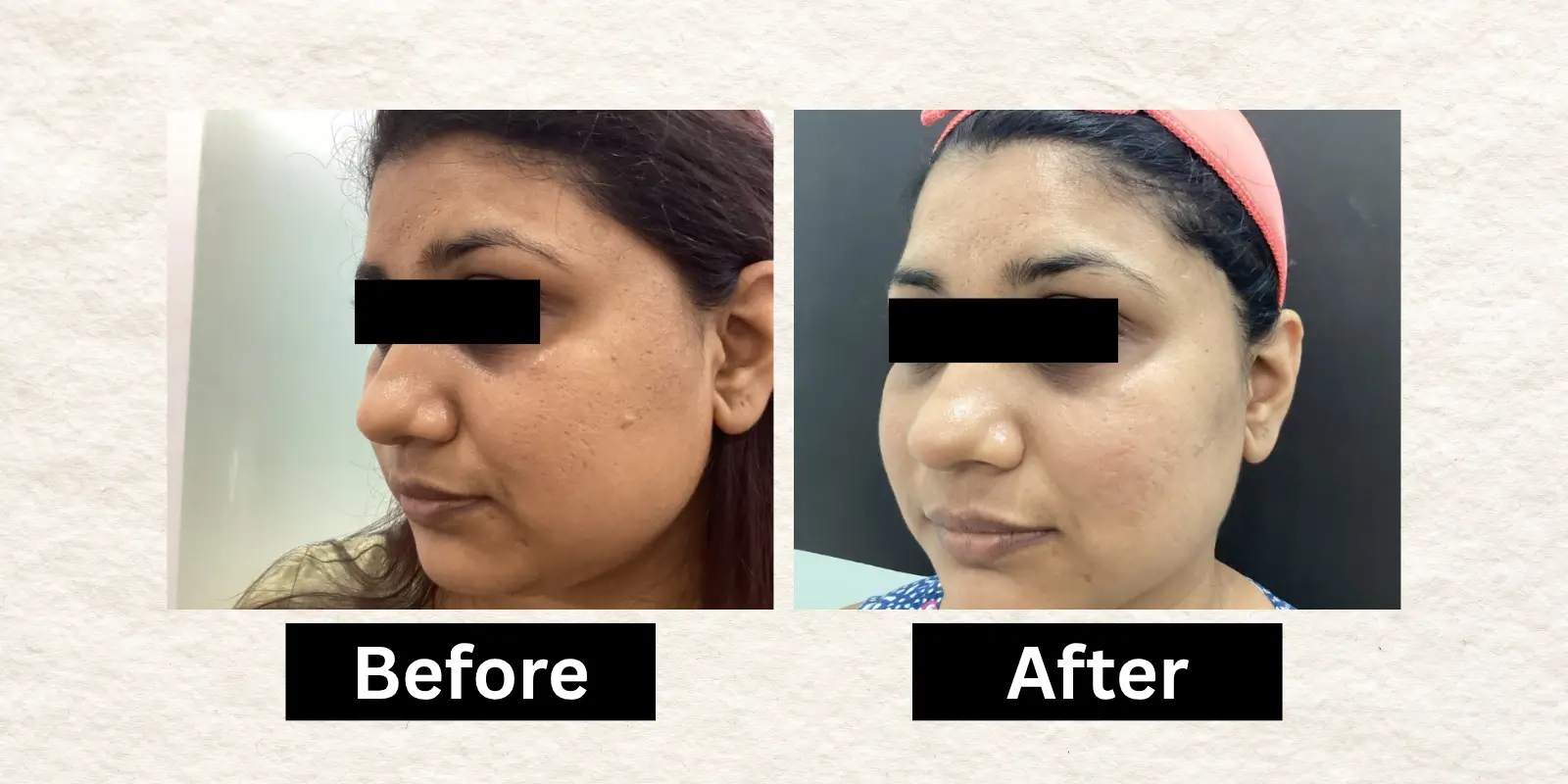 Before After 12