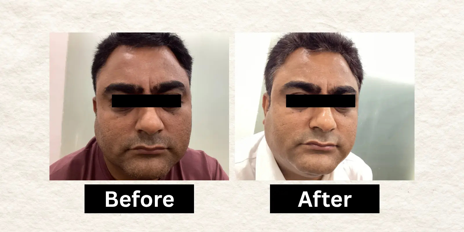 Before After 17