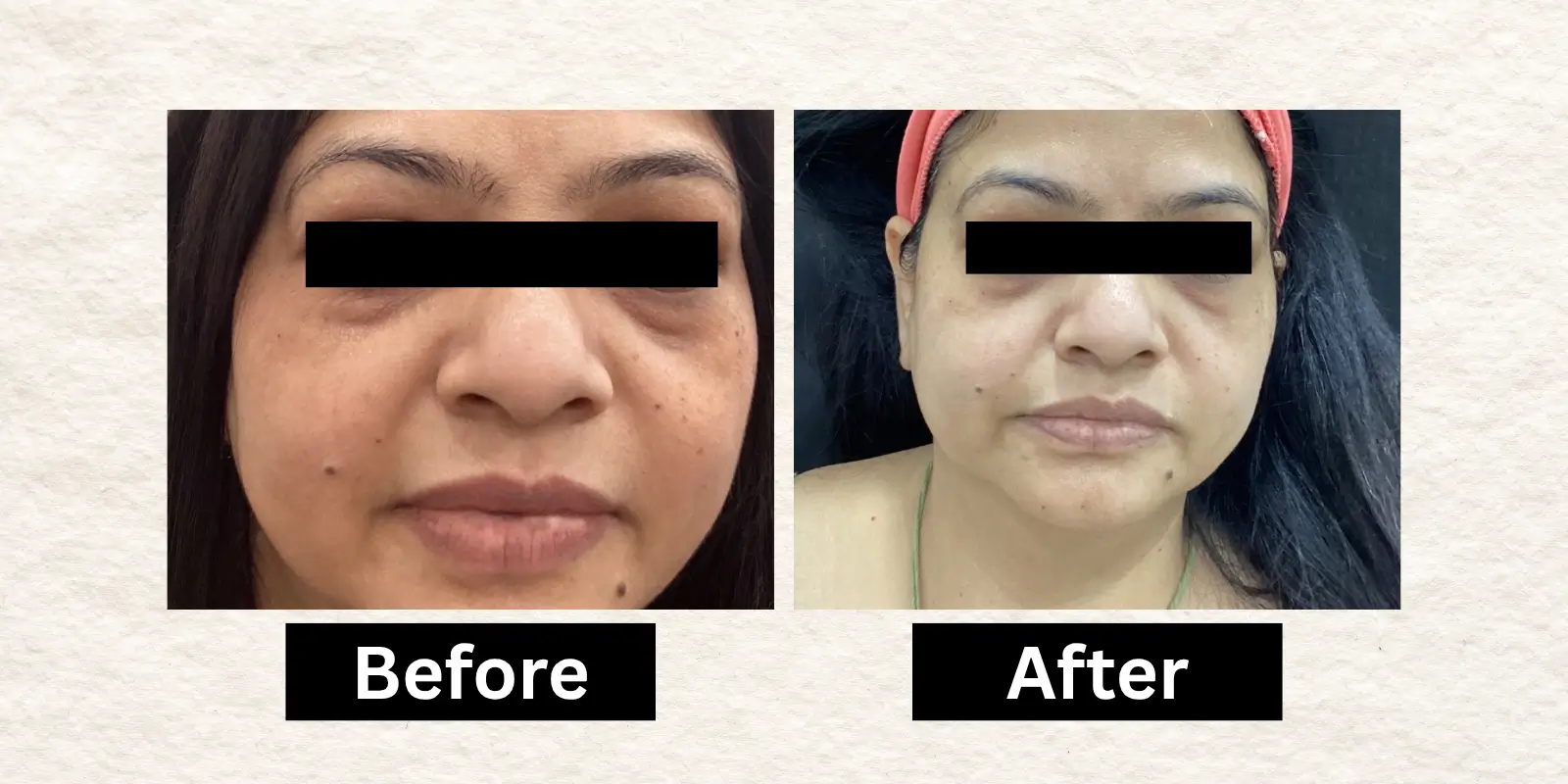 Before After 2