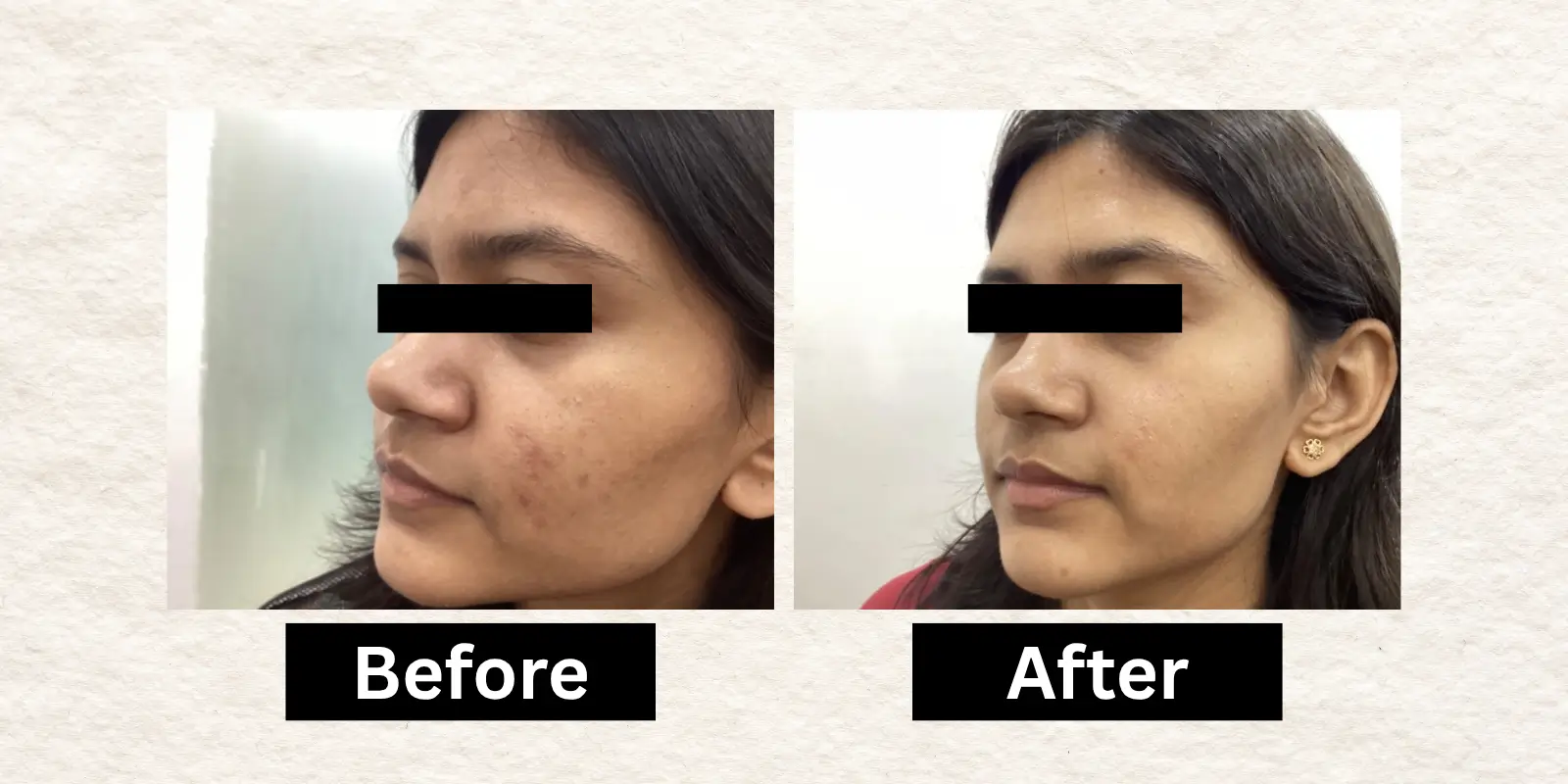 Before After 3