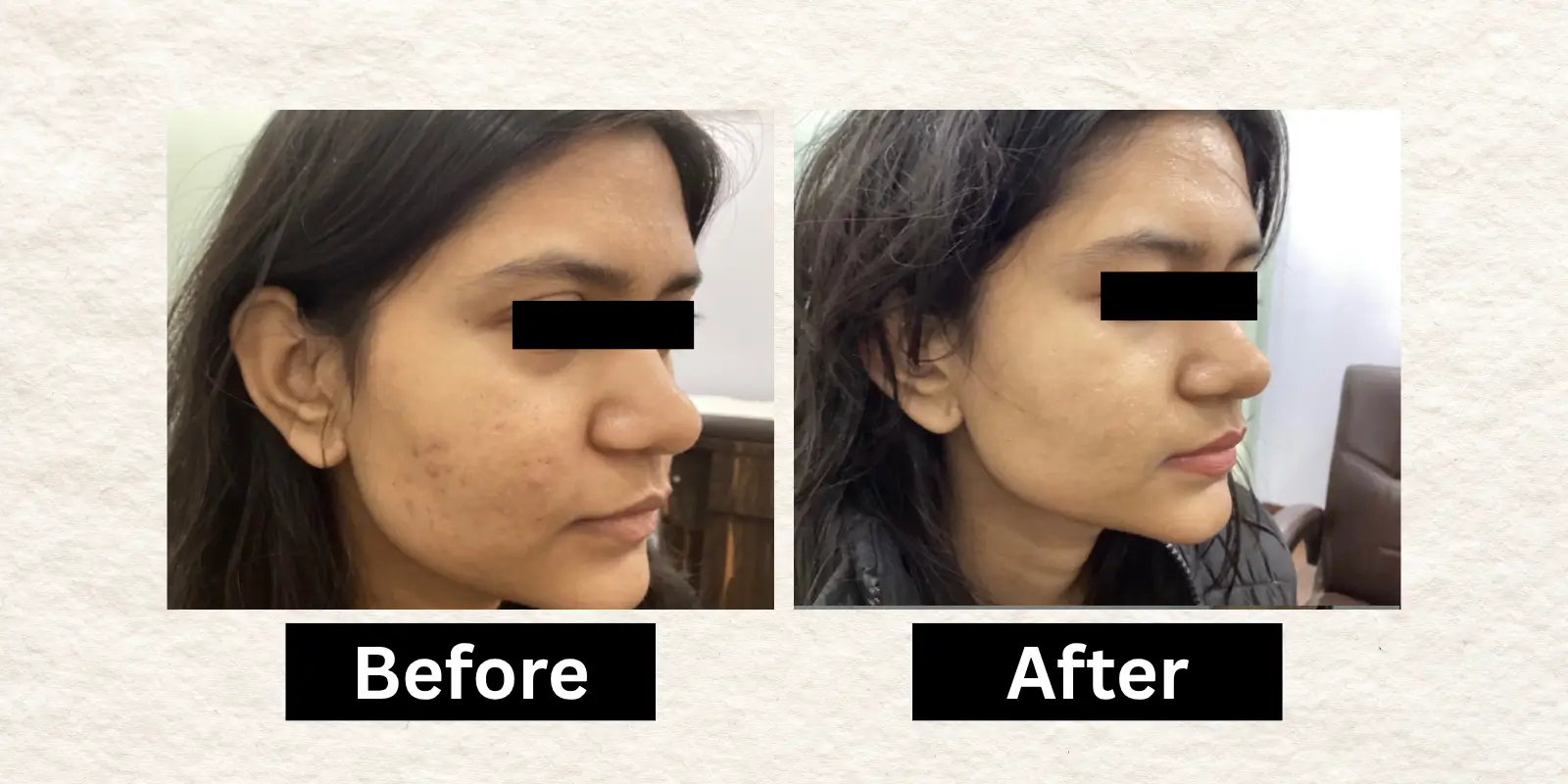 Before After 4