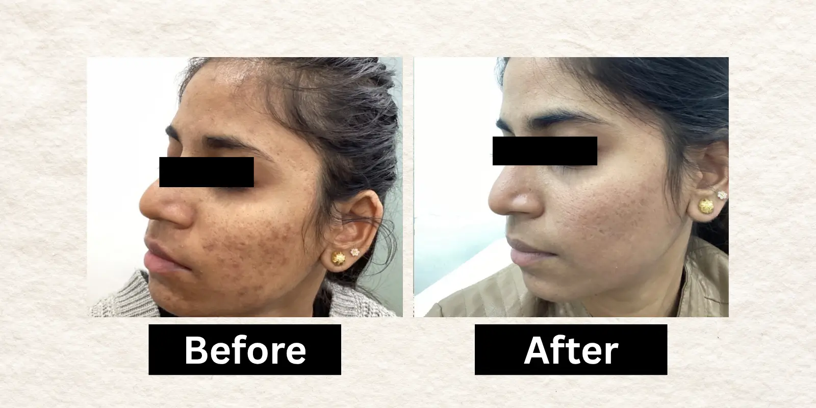 Before After 5