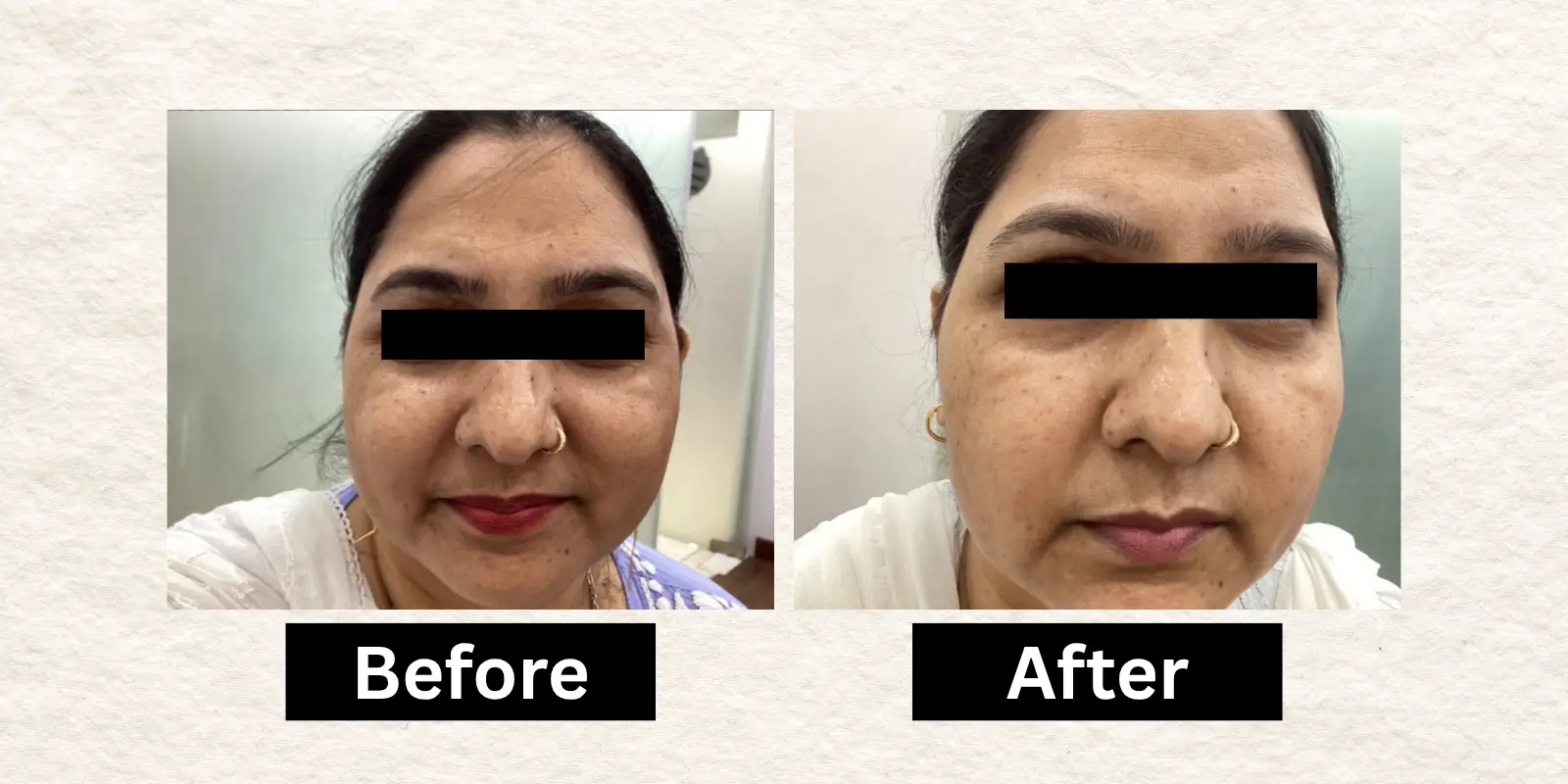Before After 6