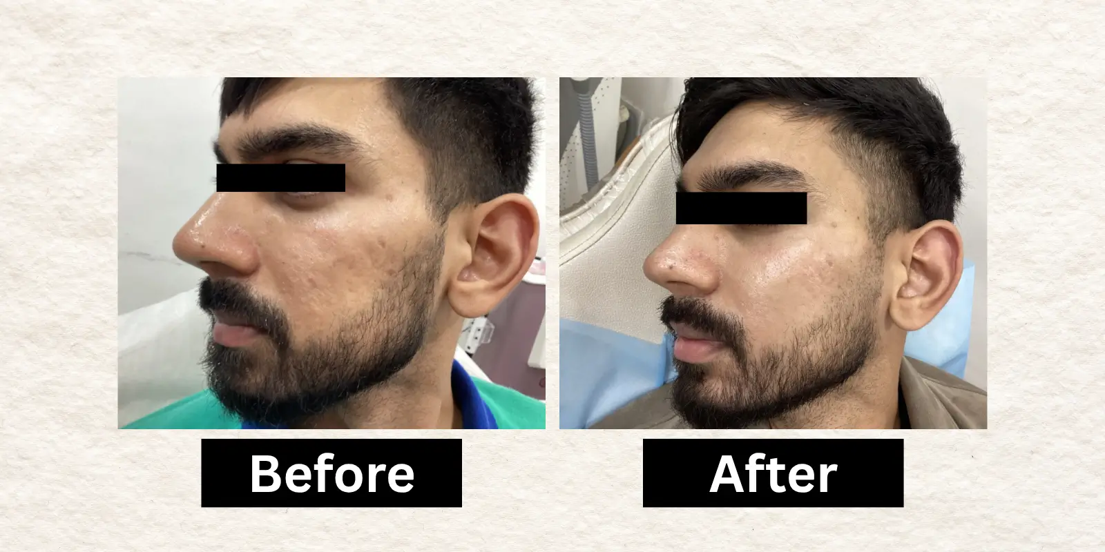 Before After 7