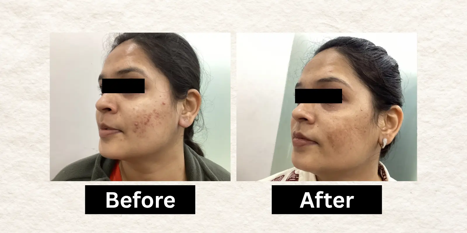 Before After 8