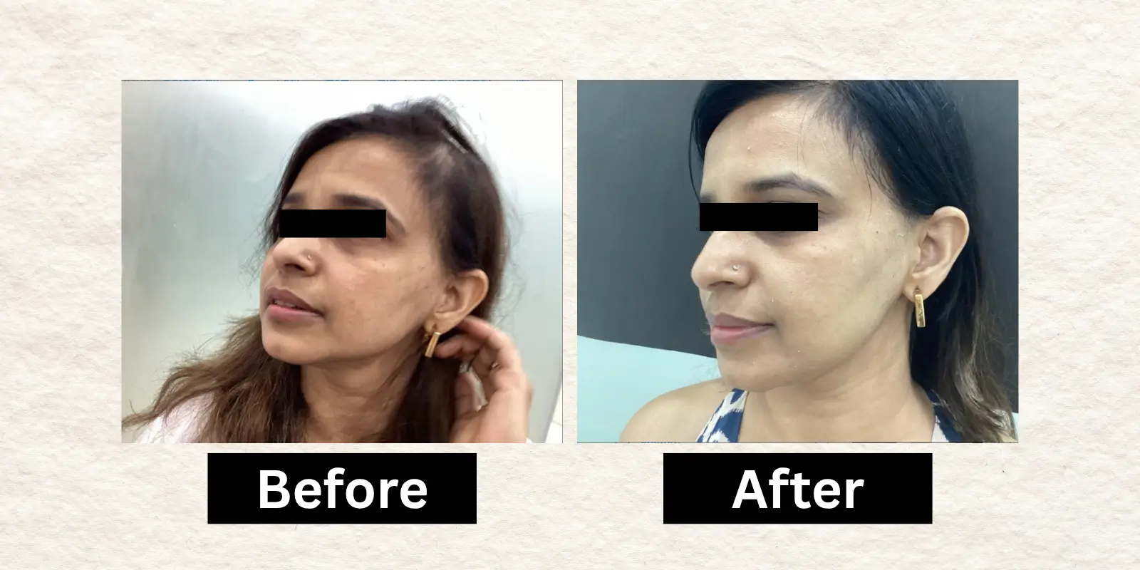 Before After 9